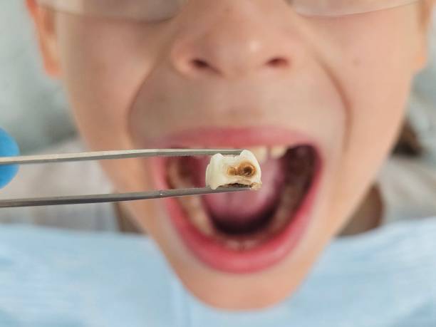 Best Emergency Tooth Extraction  in Dent, OH